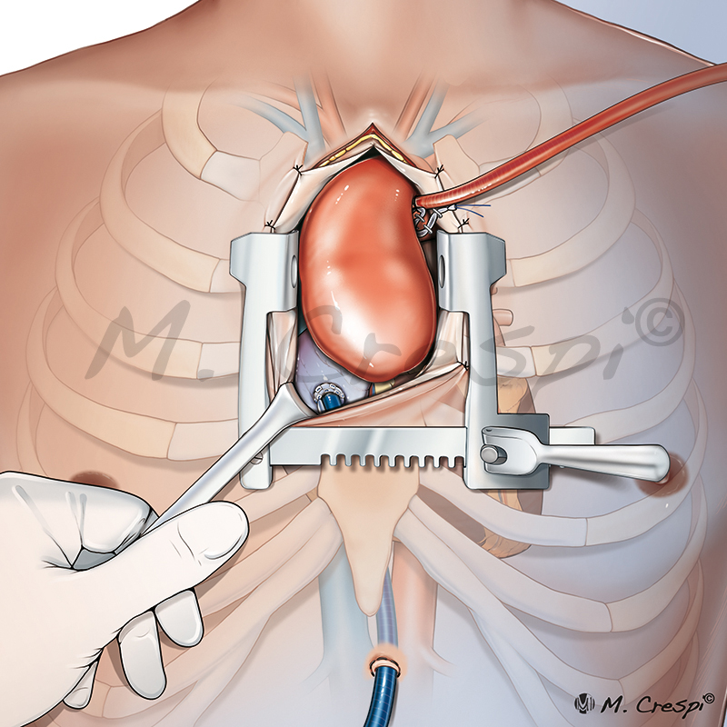 Minimally invasive aortic root surgery (or ascending aorta aneurysm)