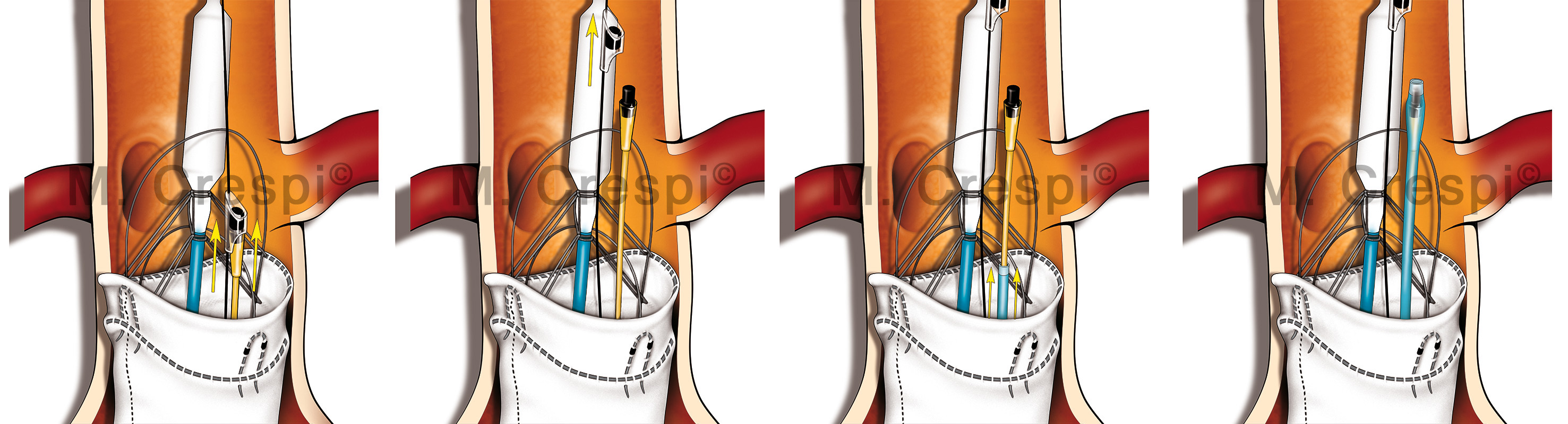 Anaconda endovascular prosthesis