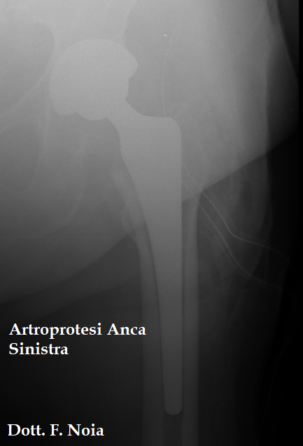 Artroprotesi Anca sinistra - Dott. F. Noia