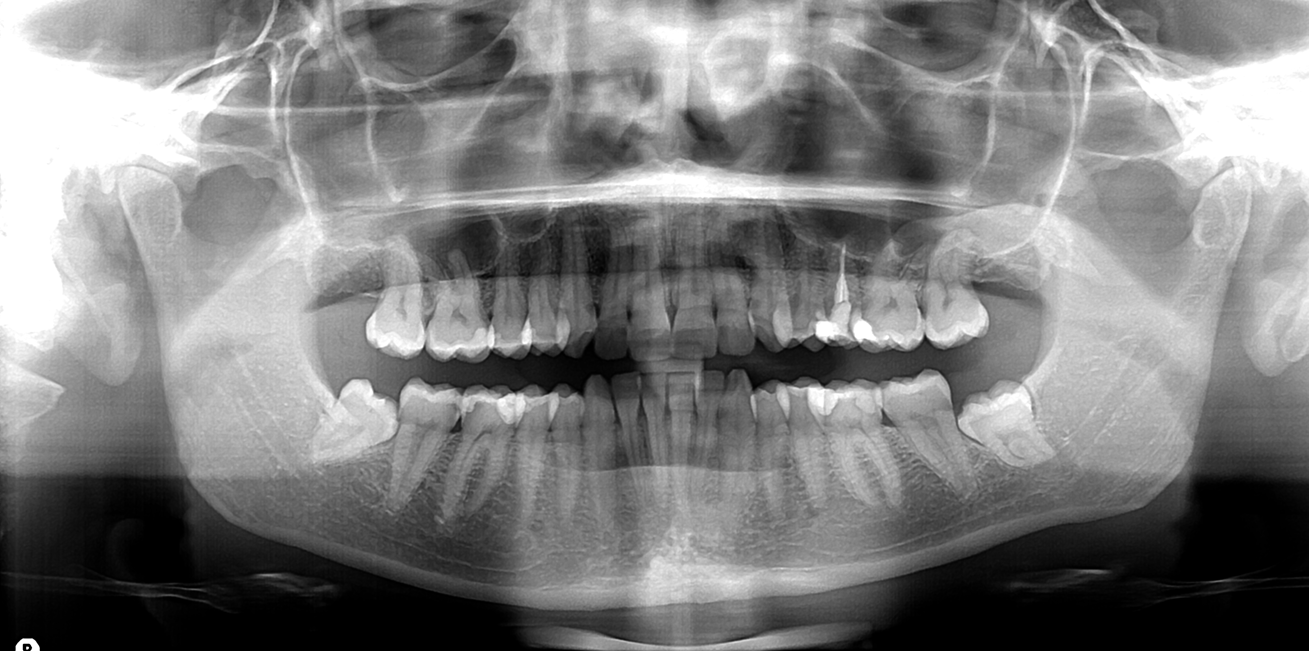 Radiografie dentali, sono rischiose per la salute?