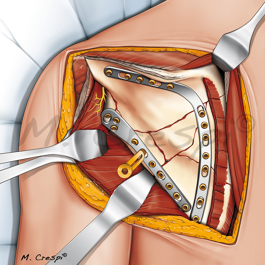 Surgery in the fracture of the scapula