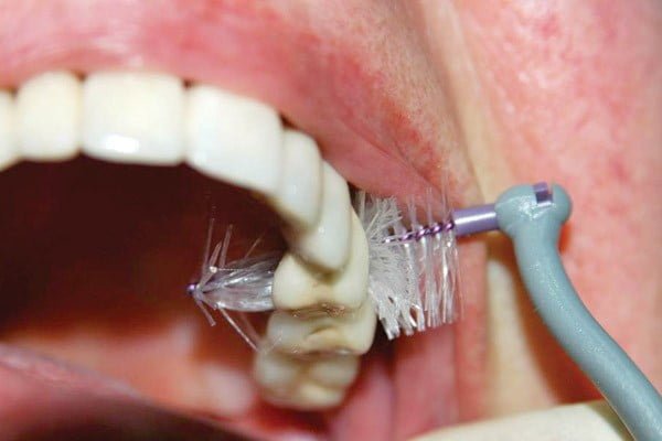 Pulizia e igiene quotidiana degli impianti dentali