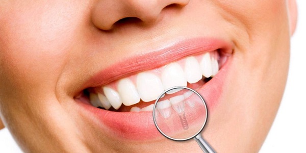 Implantologia dentale: quali sono le controindicazioni e rischi?