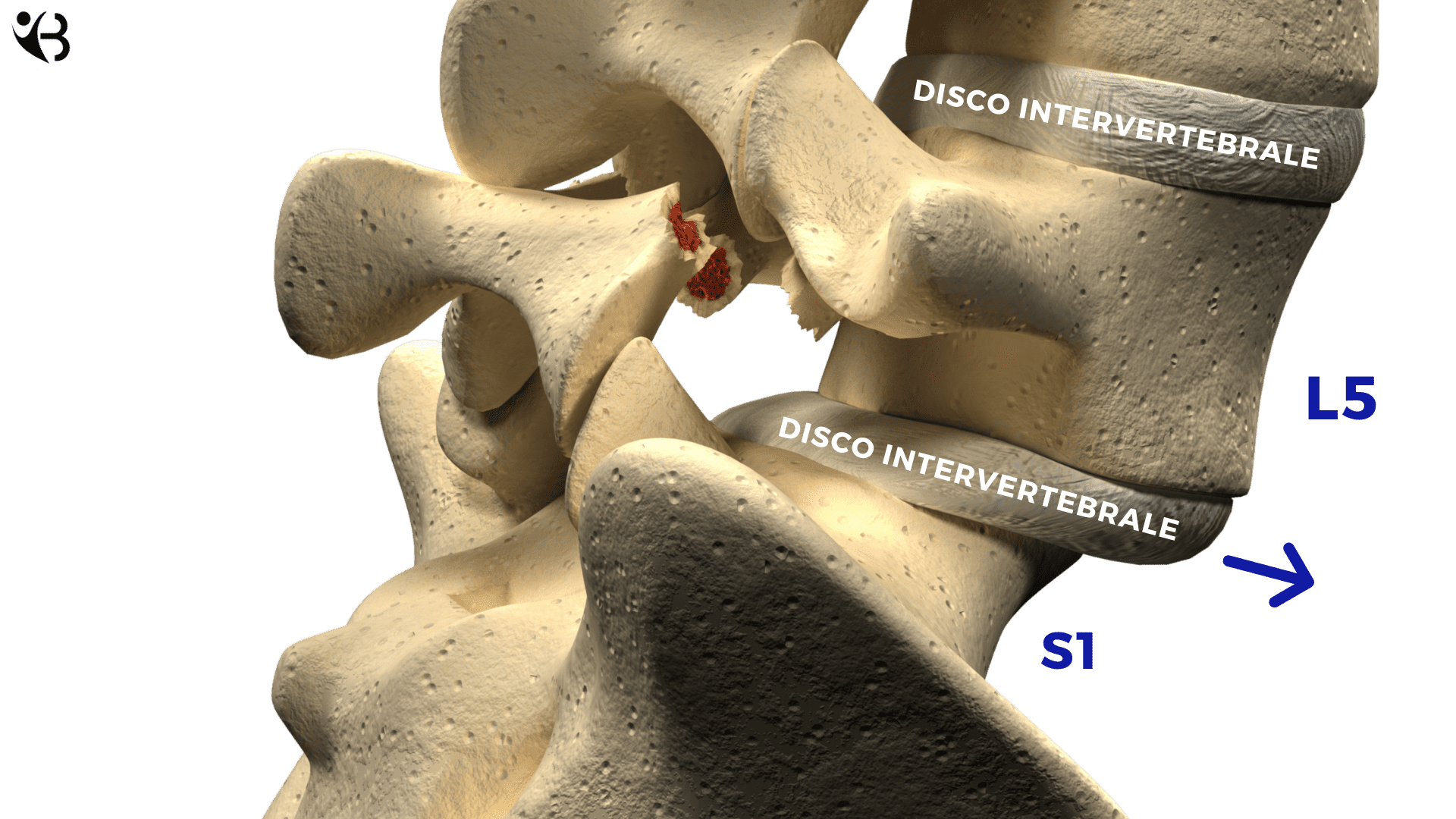 Spondilolisi