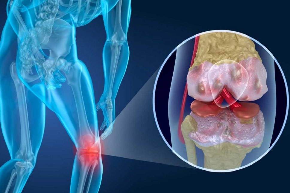 Terapia del campo elettromagnetico pulsato per il trattamento dell'artrosi del ginocchio