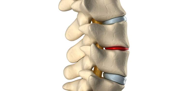 Malattia degenerativa del disco