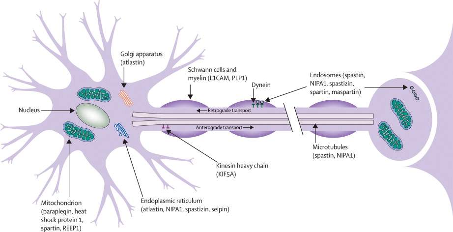 Hereditary spastic paraplegia