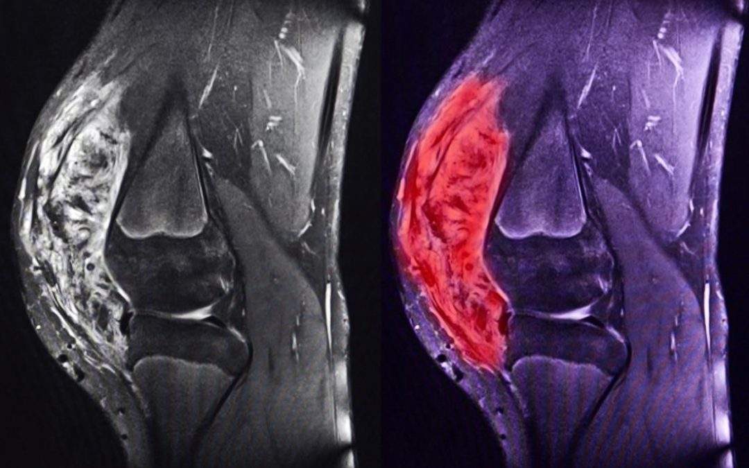 Osteosarcoma mammario