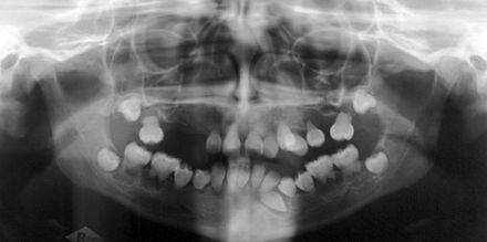 Displasia della dentina con ossa sclerotiche