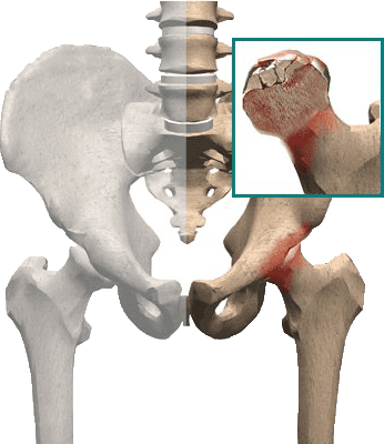 I campi elettromagnetici pulsati proteggono l'equilibrio tra adipogenesi e osteogenesi nell'osteonecrosi del femore