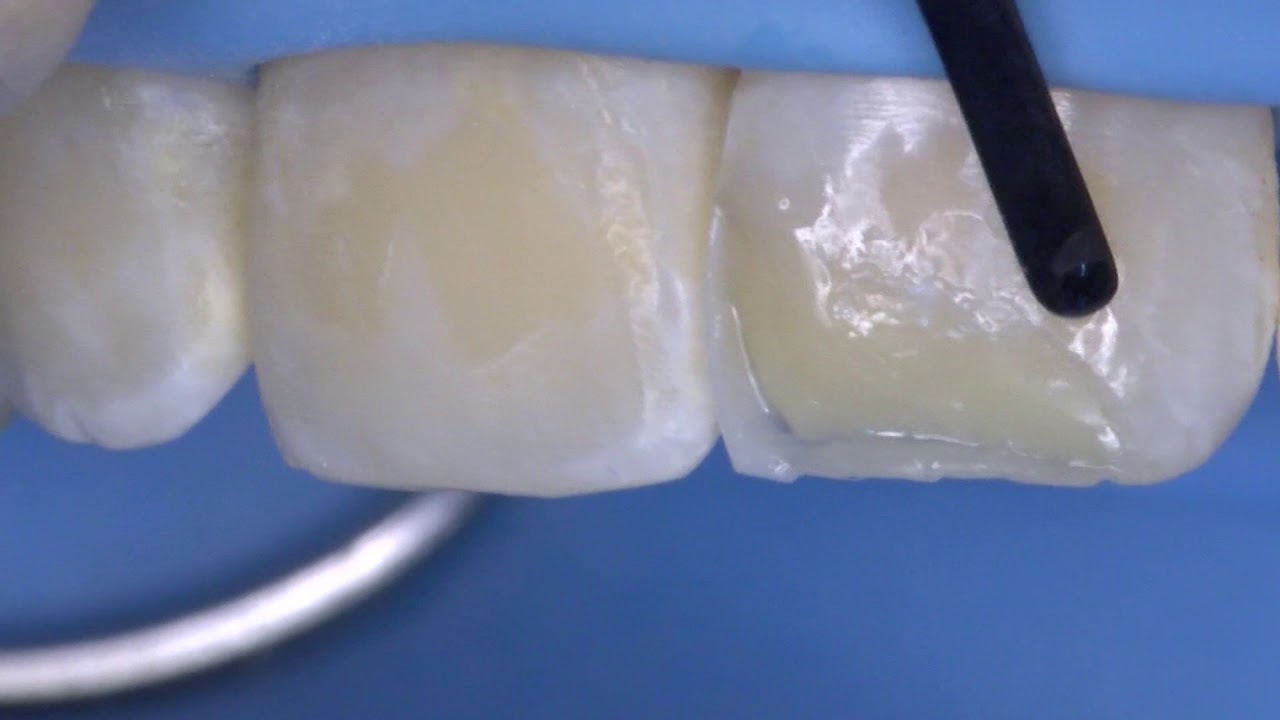 Le ricostruzioni estetiche sono eseguite utilizzando materiali compositi che aderiscono fortemente ai tessuti naturali del dente (smalto e dentina) grazie ad un sistema adesivo.