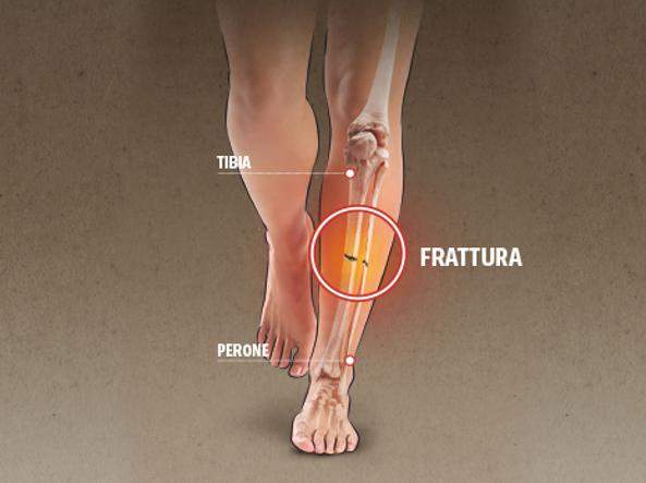 Trattamento delle fratture tibiali non unite: un confronto tra chirurgia e campi elettromagnetici pulsati (PEMF)