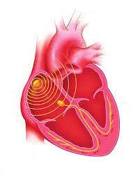 Stimolazione cardiaca con campo elettromagnetico pulsato