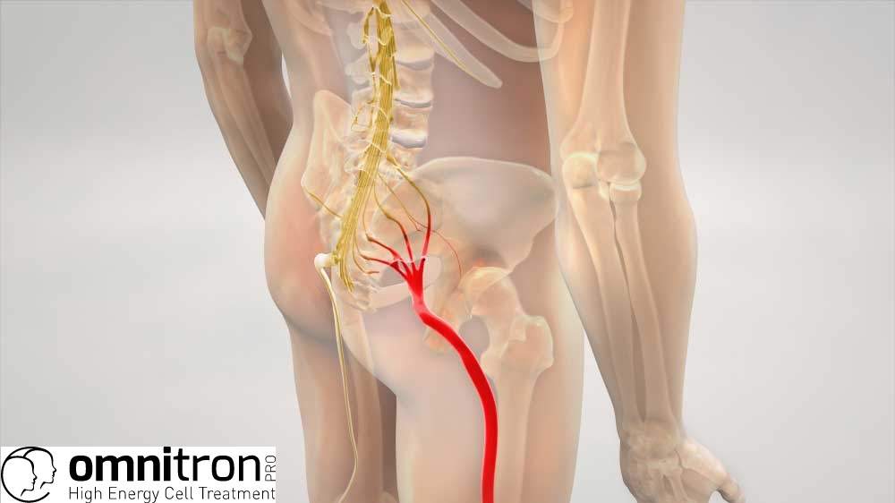 Stimolazione magnetica periferica ripetitiva (rPMS) in soggetti con radicolopatia lombare