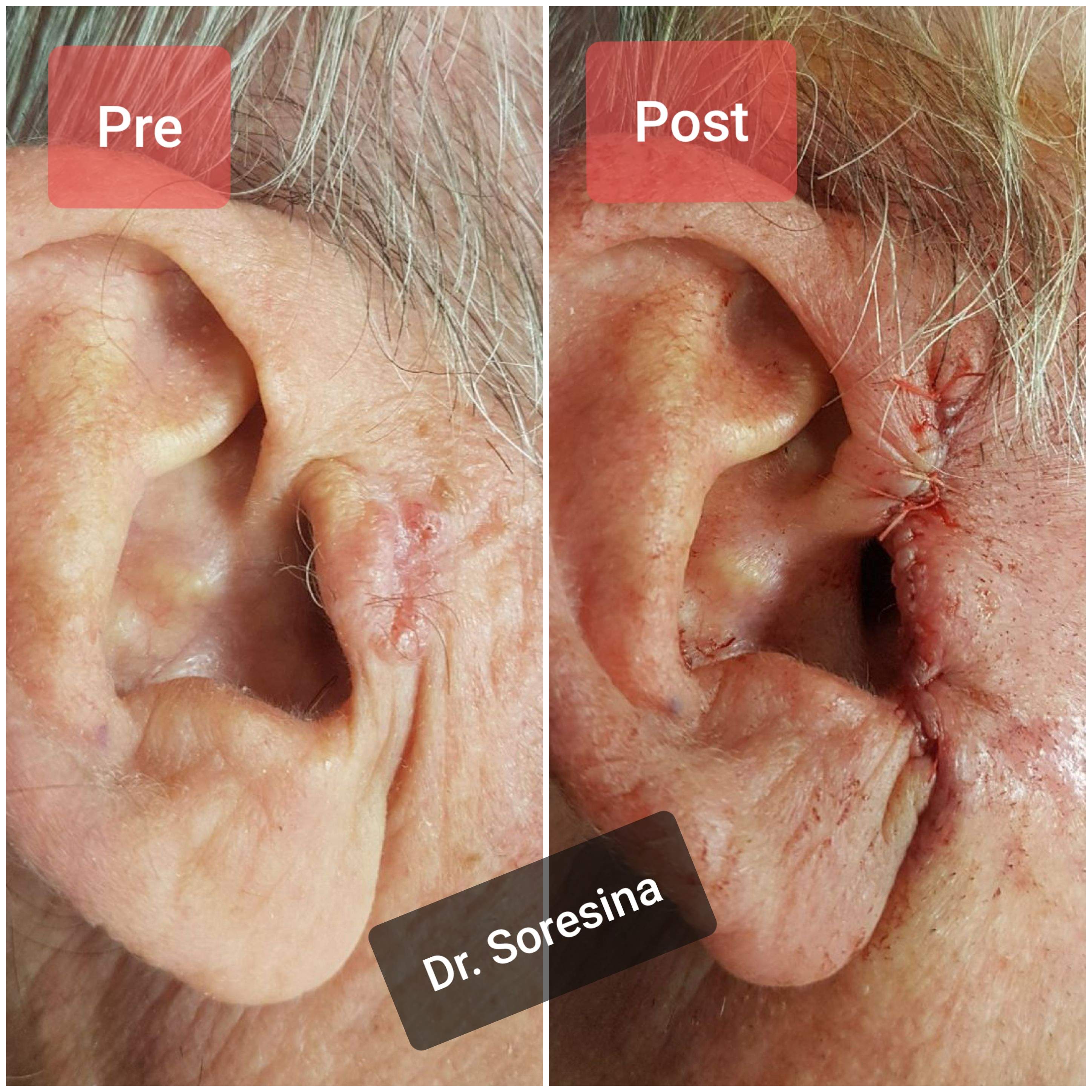 carcinoma spinocellulare orecchio, ricostruzione orecchio