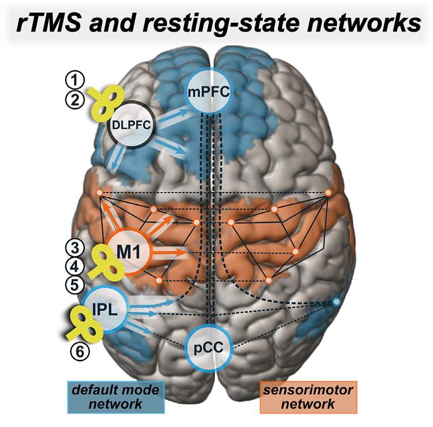 Come funziona il trattamento rTMS stimolazione magnetica transcranica?