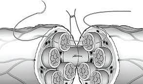 La lesione da transezione del nervo periferico: il ruolo della terapia del campo elettromagnetico pulsato