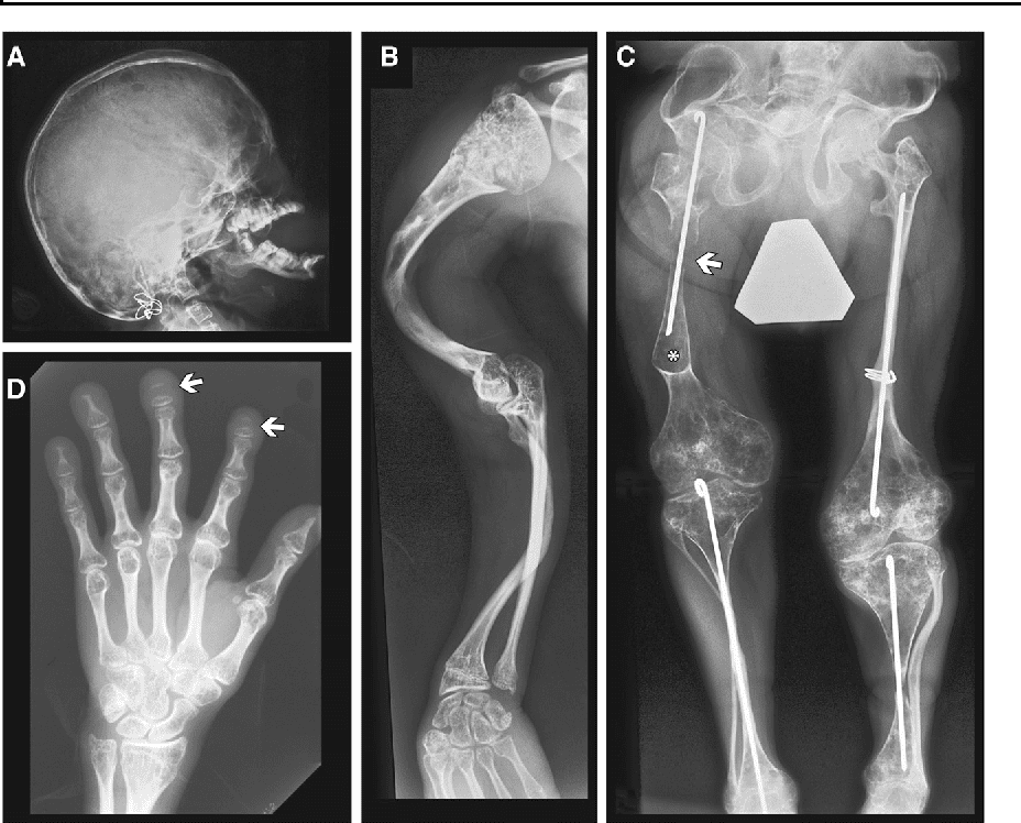 Sindrome del carpentiere 1 ( CRPT1 )