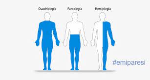 La terapia di stimolazione magnetica periferica ripetitiva (rPMS) per emiparesi dell'arto superiore dopo ictus