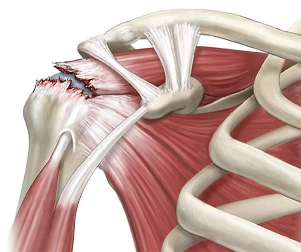 Effetto della terapia con campo elettromagnetico pulsato in pazienti con rottura del tendine sovraspinato