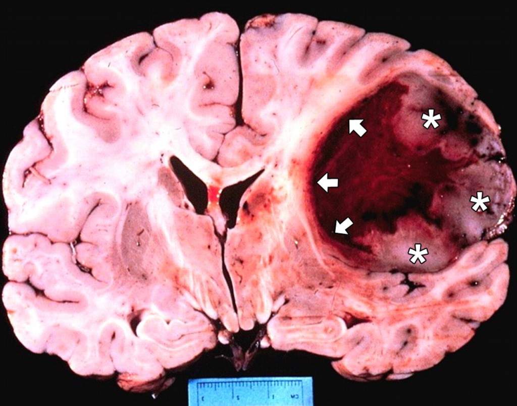 EFFETTI DELL'ESPOSIZIONE PEMF SULLE CELLULE DI GLIOBLASTOMA