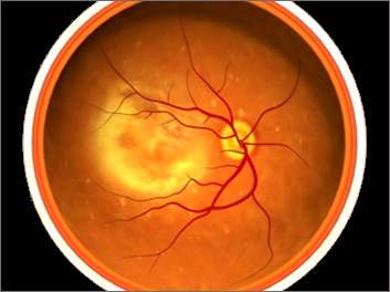 Patologie degli occhi - Casi studio HECT/PEMF omnitron-pro. Degenerazione maculare secca.  Rapporto: Dr. I. Bunke, Burgdorf Hannover