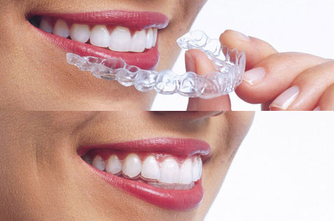 L'ortodonzia invisibile, in odontoiatria, è un insieme di tecniche utilizzate per riallineare i denti in modo che i dispositivi utilizzati non possano essere visibili dall'esterno e creare disagio al paziente.