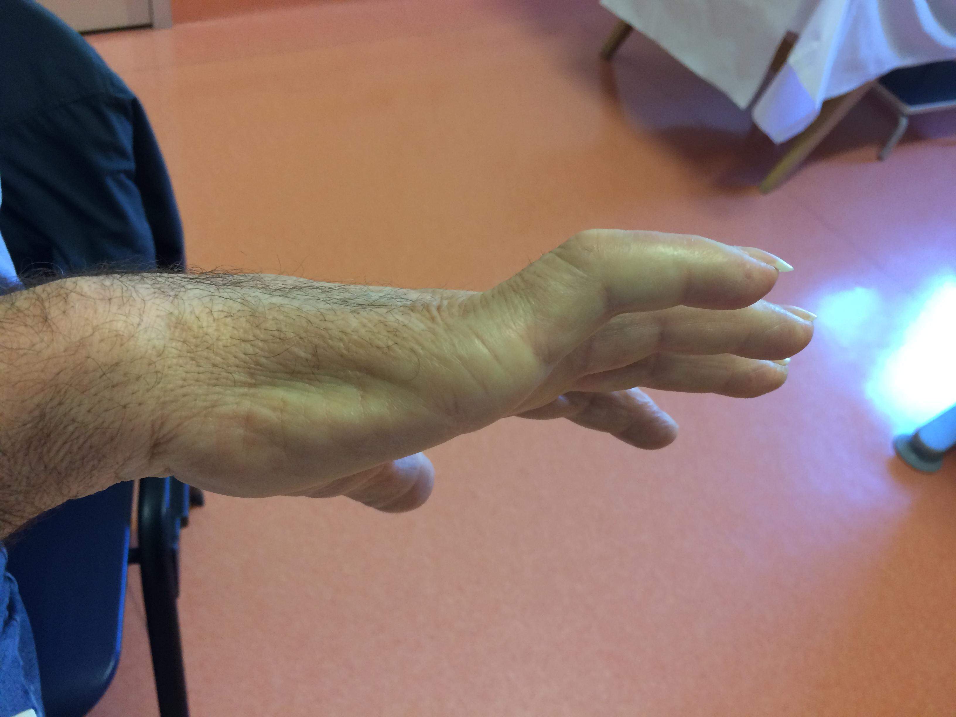 Cubital Tunnel Syndrome. The ulnar nerve originates from the…, by Nabil  Ebraheim
