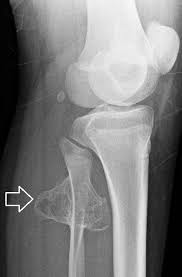 Osteocondroma