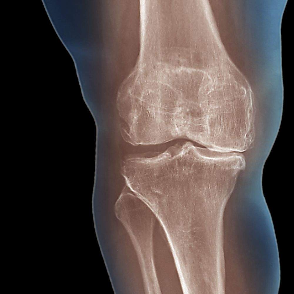 Long-term effects of multiple fractures and osteoarthritis