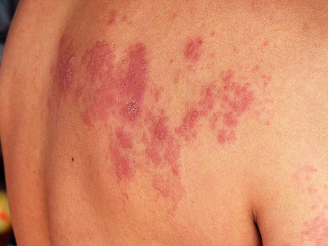 TRATTAMENTI PEMF PER RIDURRE IL DOLORE DURANTE E DOPO L'HERPES ZOSTER